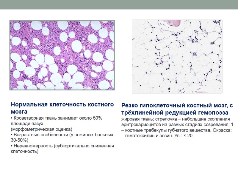 Нормальная клеточность костного мозга  Кроветворная ткань занимает около 50% площади пазух (морфометрическая оценка)